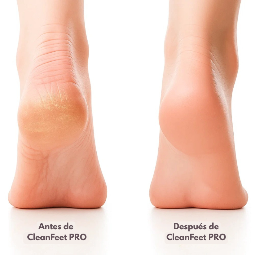 CleanFeet Pro: Removedor de callos de pies EN MINUTOS
